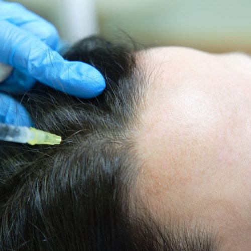 4: Con una aguja muy fina y estéril se hacen varias inyecciones en el cuero cabelludo. El PRP actúa como un fertilizante natural que mejora la circulación y la nutrición de los folículos pilosos.