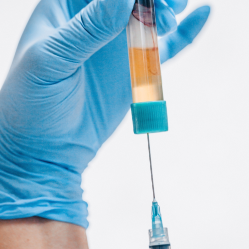 3: Se prepara el plasma rico en plaquetas (PRP), que es el plasma con una concentración más alta de plaquetas de lo normal.