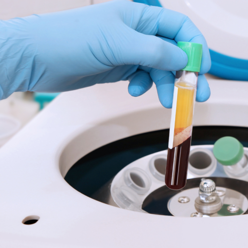 2: Se procesa la sangre en una centrífuga que separa el plasma del resto de sus componentes. El plasma contiene las plaquetas, que son células que ayudan a la cicatrización y a la regeneración de los tejidos.